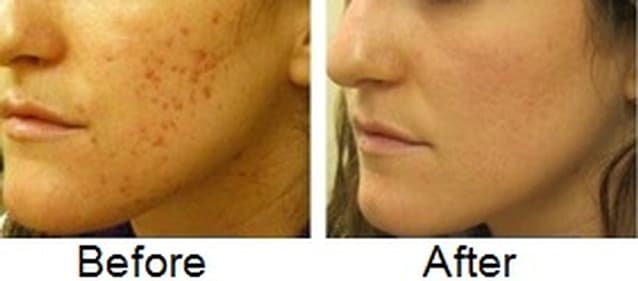 Before and after treating acne scars with lemon extract. Note that pigmentation is lighter in the second picture and the complexion is improved.