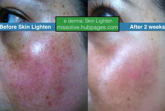 Left cheek: before and after using Skin Lighten by derma e for 2 weeks. Reviewer has reacurring melasma.