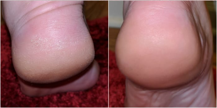 This step makes a seriously HUGE difference! See my before an after? My feet are smooth and feel great. Since there's no dry skin left, I don't feel like my skin catches on certain fabrics anymore.