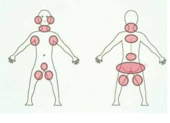 These bruising areas are less likely to be from the normal activities of a child. These areas are more often associated with signs of abuse. A bruise in one area is not generally indicative of abuse, but bruises in several areas, or the same area is