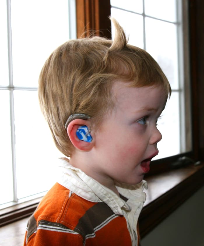 Hearing loss will cause both receptive and expressive language delays, and must be ruled out when a delay is suspected or confirmed.