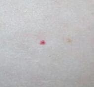 een rode mol is meestal een goedaardige groei die te wijten is aan de overmatige groei van kleine bloedvaten. Gebeurt tijdens de zwangerschap vanwege hormonen. 