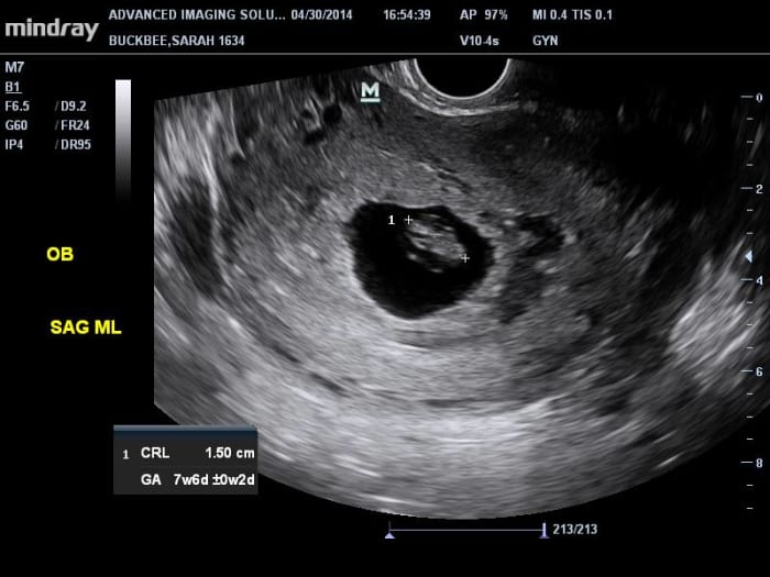 The empty sac on the right side indicates a twin that didn't make it past the embryonic stage. See the blood in the lower half of the sac.