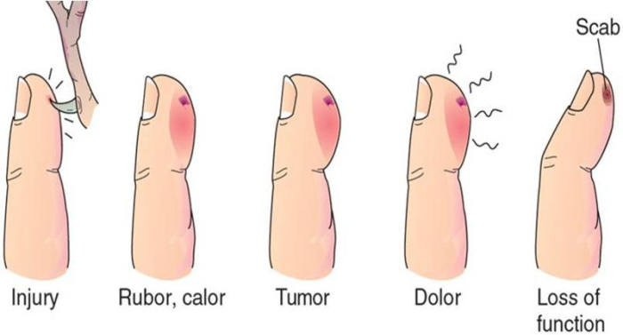 Signs of inflammation - Rubor ( redness) , Calor ( heat), Tumor ( swelling), Dolor ( pain) and Functiolacea ( loss of function)