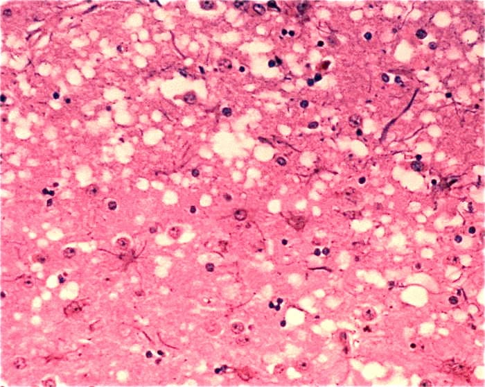 The "holes" that are visible in the brain of a cow with BSE; similar holes develop in a person with a TSE, or Transmissible Spongiform Encephalopathy