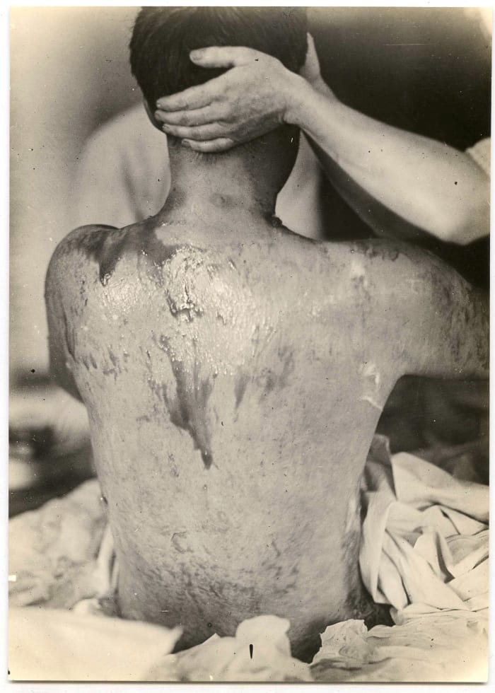 A soldier being treated for mustard gas burns during World War I