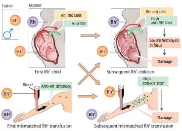 Rh antigen incapability in pregnancy. Source: http://medchrome.com/wp-content/uploads/2012/12/Rh-isoimmunization.jpg