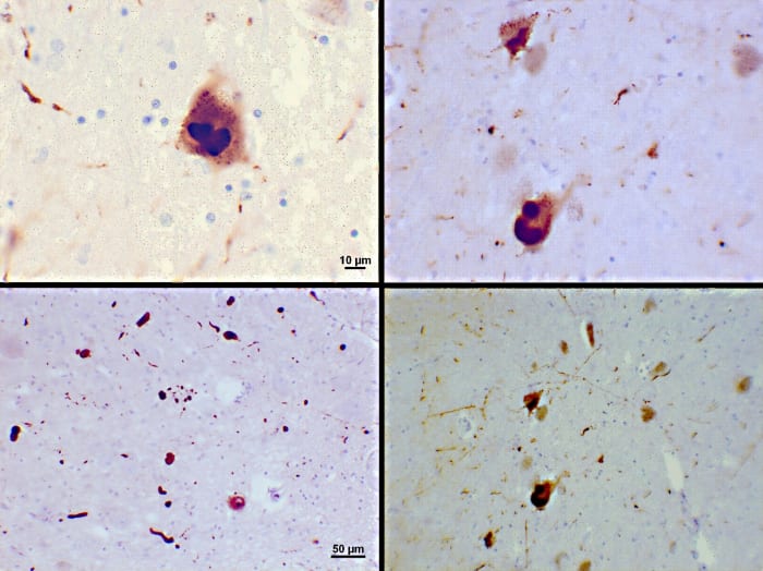 Stained slides showing Lewy bodies (the dark brown patches) in the brain of a Parkinson's disease patient