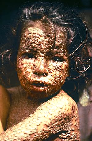 A Bangladeshi child who was affected by smallpox in 1973. Thanks to the work of people like Doctor Donald Henderson and his team, a sight like this will hopefully never be seen again, anywhere in the world