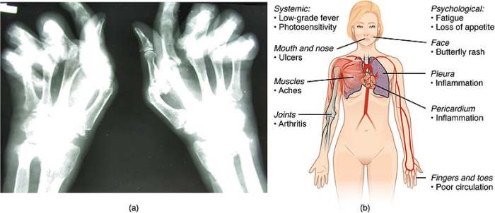 Visualizations of rheumatoid arthritis (left) and lupus (right), both autoimmune disorders.