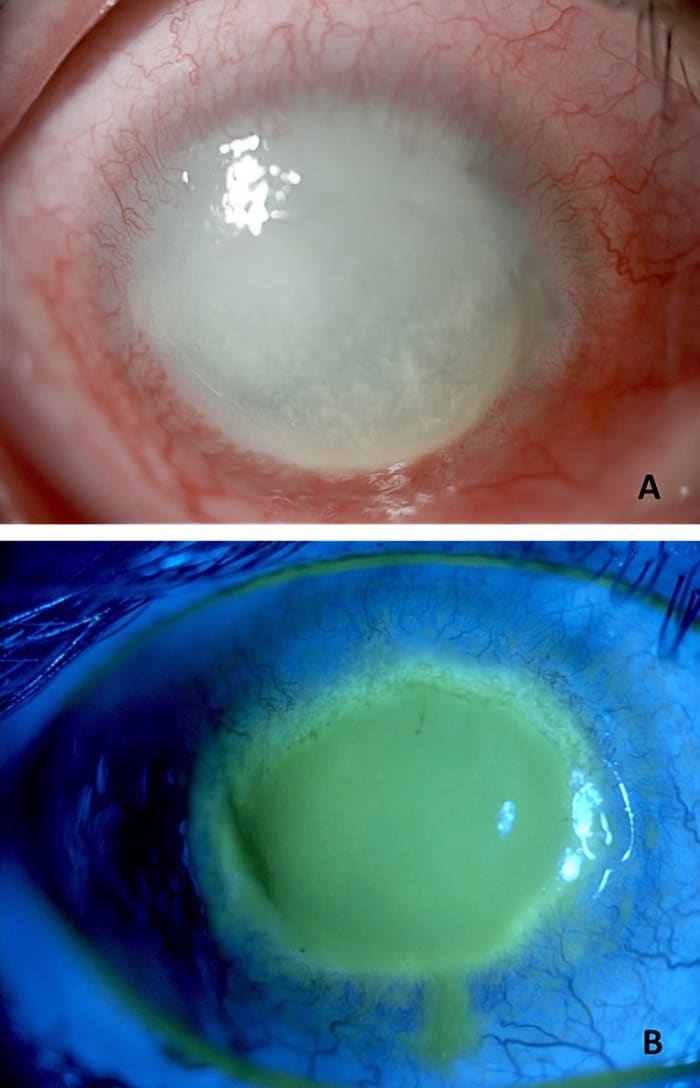 The cornea in Acanthamoeba keratitis