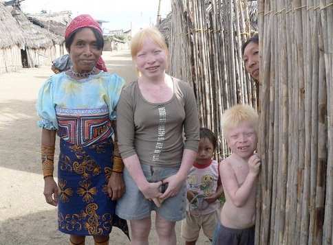 "Deadly tropical sun for the albinos of Panama’s ethnic Kuna" Costa Rica Star News
