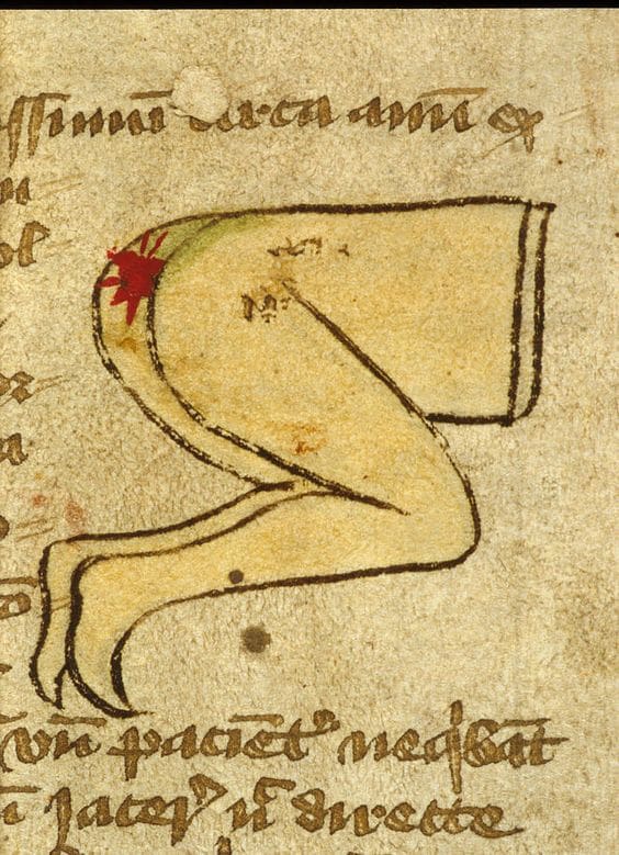 five-ancient-medical-treatments-we-consider-insane-today