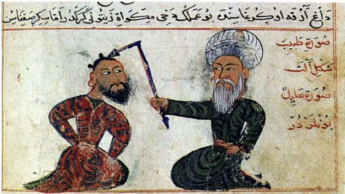 "Epilepsy treatment from the surgical atlas Cerrahiyetül Haniye (Imperial surgery). Drawn in the 15th century (1465). Collection: Ataturk Institute for Modern Turkish History, Istanbul, Turkey. Artist: Sefereddin Sabuncuo ğ lu" Research Gate