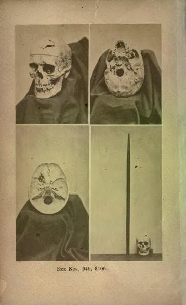 Actual Skull of Phineas Gage. Bottom left is the tamping iron shown beside the skull.