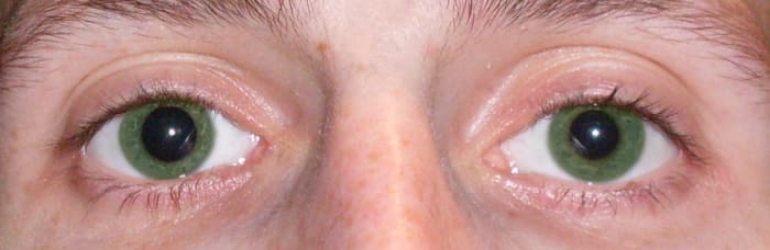 This is an example of anisocoria in green eyes! Talk about rare!