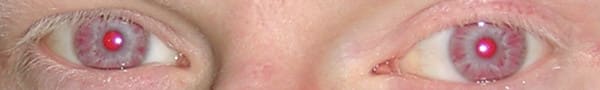 Albino eyes look can look red or pink due to the lack of pigment in the iris.
