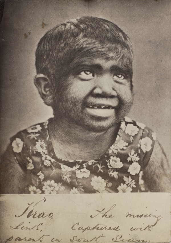 Krao was abducted and shown from a very young age. While the showmen who profited from her appearance claimed she was a "missing link," the child was completely human and simply had a genetic condition causing increased hair growth.