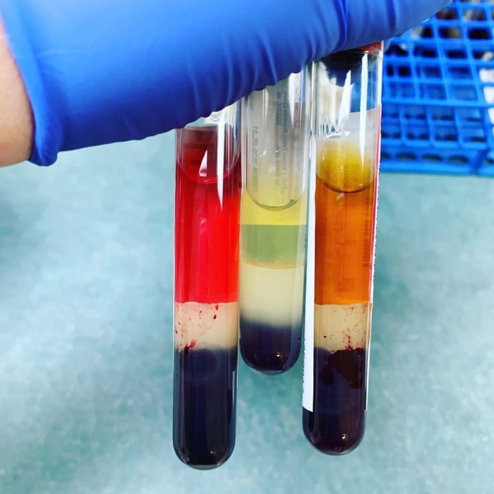 Serum separated from blood by a gel layer. The red appearance in the first tube is because of a bad draw. The second tube shows normal serum after a perfect draw. The brownish yellow appearance in third tube shows liver issues.