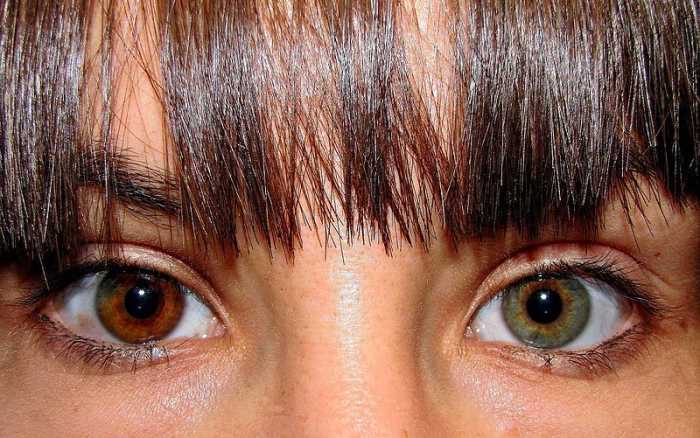 A woman with Heterochromia Iridium.