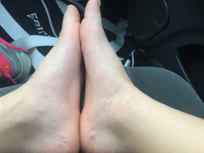 As soon as we hit the truck after the meet, my daughter removed her socks and shoes. I'm used to seeing her swollen here and there, but I knew this was a different kind of swollen. Unfortunately, it only got worse from here.
