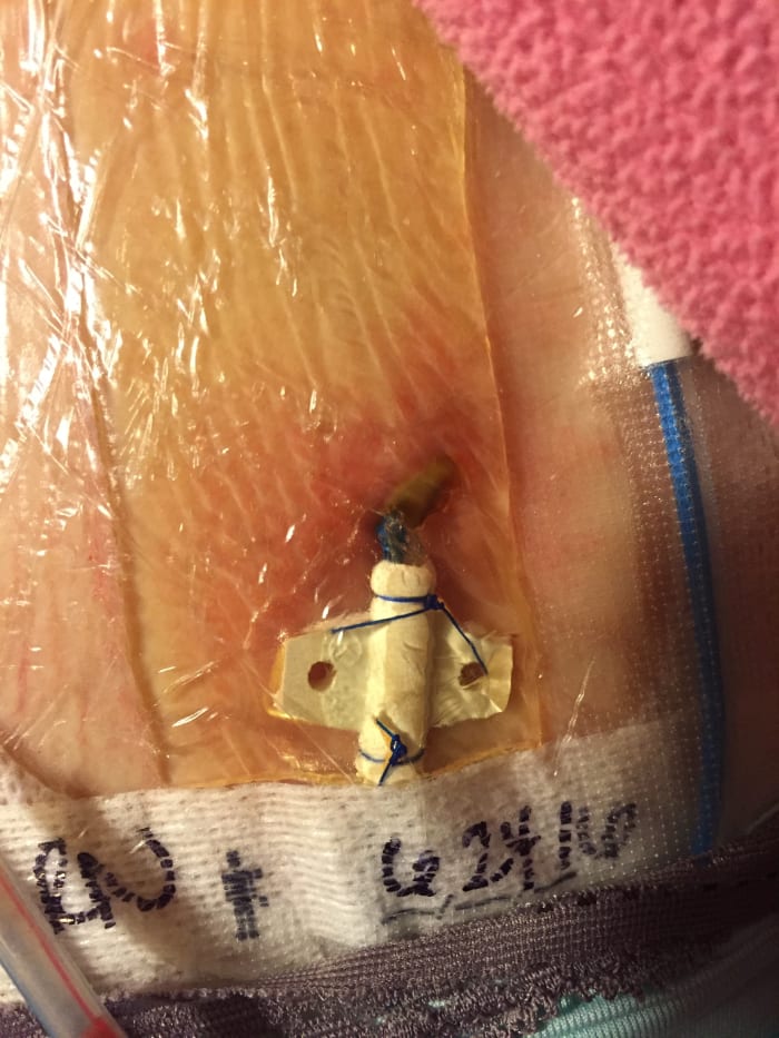 This is an infected central line. If this happens, they will pull out the infected line and give antibiotics. They will then replace another line about a week later (depending on your infectious disease Dr.)