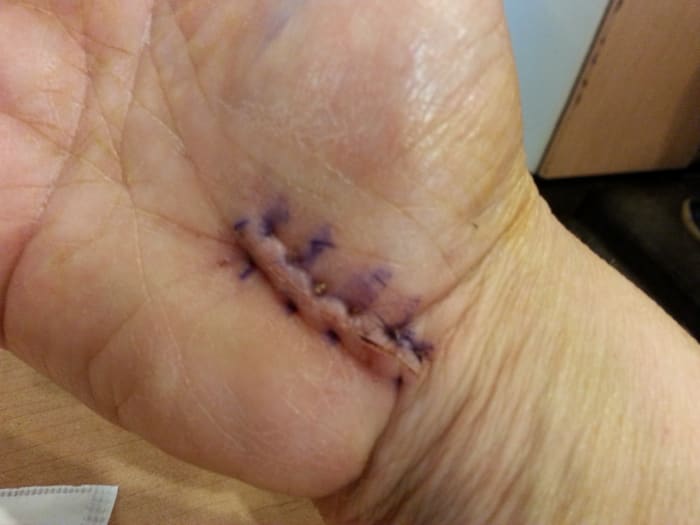 This is what the wound looked like one week post-op when the bandages came off. It wasn't pretty, but it was a relief to get the giant bandage off my hand. It looks big and scary in the photo, but it's only about 1 1/2" long (approximately 3 cm.)