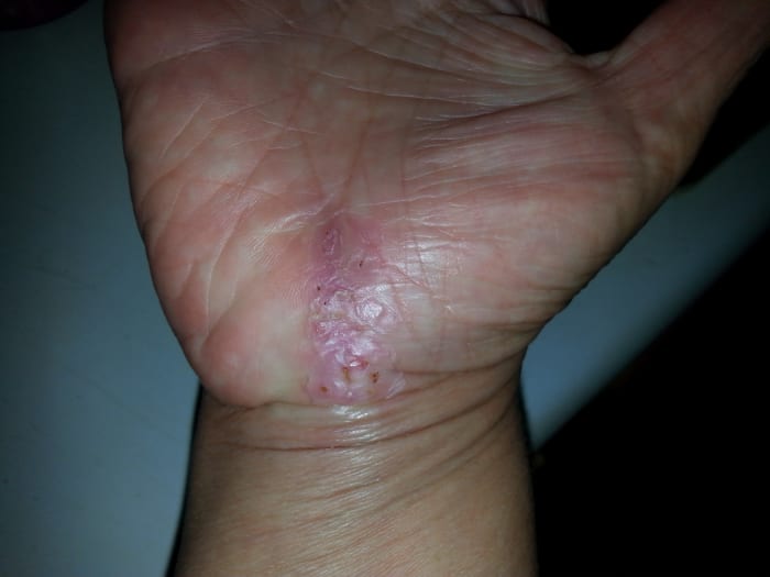 This is my hand approximately three weeks after surgery. The skin is still bumpy and peeling, but definitely on the mend. The pain was fairly constant, but not horrible.