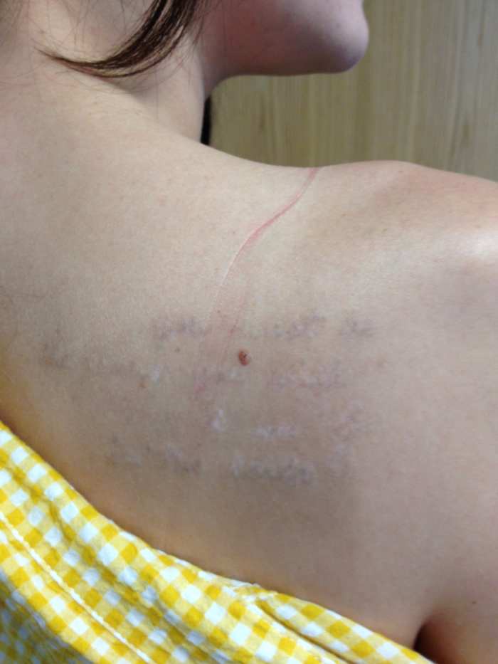 8 months after the last treatment, I still had hypopigmentation and hyperpigmentation. My body ate up a lot of the ink and was a time to get another treatment.