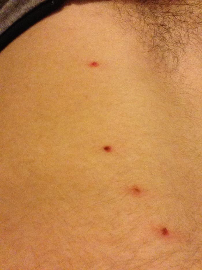 Molluscum contagiosum treated with 5% potassium hydroxide (molludab or mollutrex). Bumps become inflamed, crust over and disappear