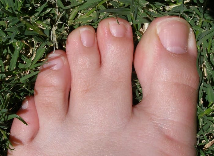 Anyone else have duck toes? Syndactyly refers webbing between human toes, typically the second and third. It occurs in about 1 in 2,000 live births.