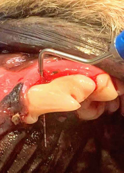 Here a "healthy looking" tooth has enough deterioration beneath the gum line that a probe can be passed between the roots externally.