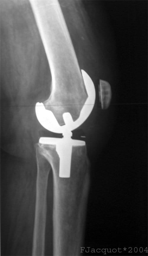 A lateral view of a total knee prosthesis is a common image if you choose a career in medical radiography.