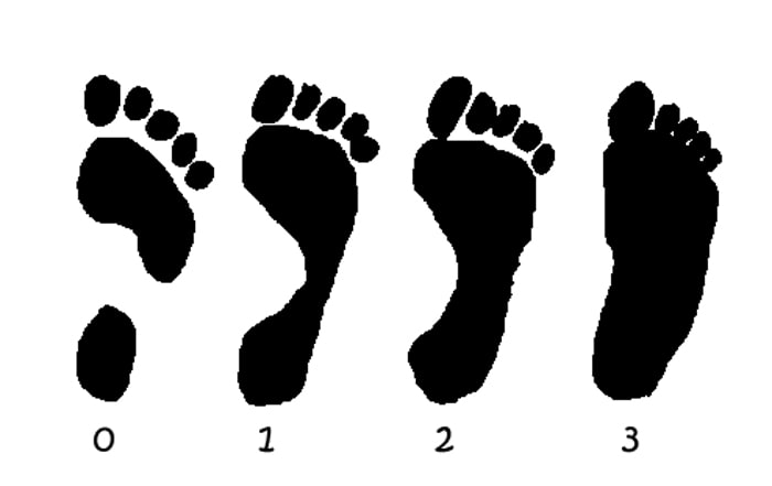 Very High Arch---------High Arch-----------Normal Arch------------Flat Feet