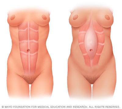 During pregnancy, the growing uterus sometimes causes the abdominal muscles to separate (diastasis recti).