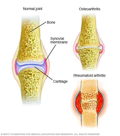 Osteoarthritis, the most common form of arthritis, involves the wearing away of the cartilage that caps the bones in your joints. With rheumatoid arthritis, the synovial membrane that protects and lubricates joints becomes inflamed, causing pain and