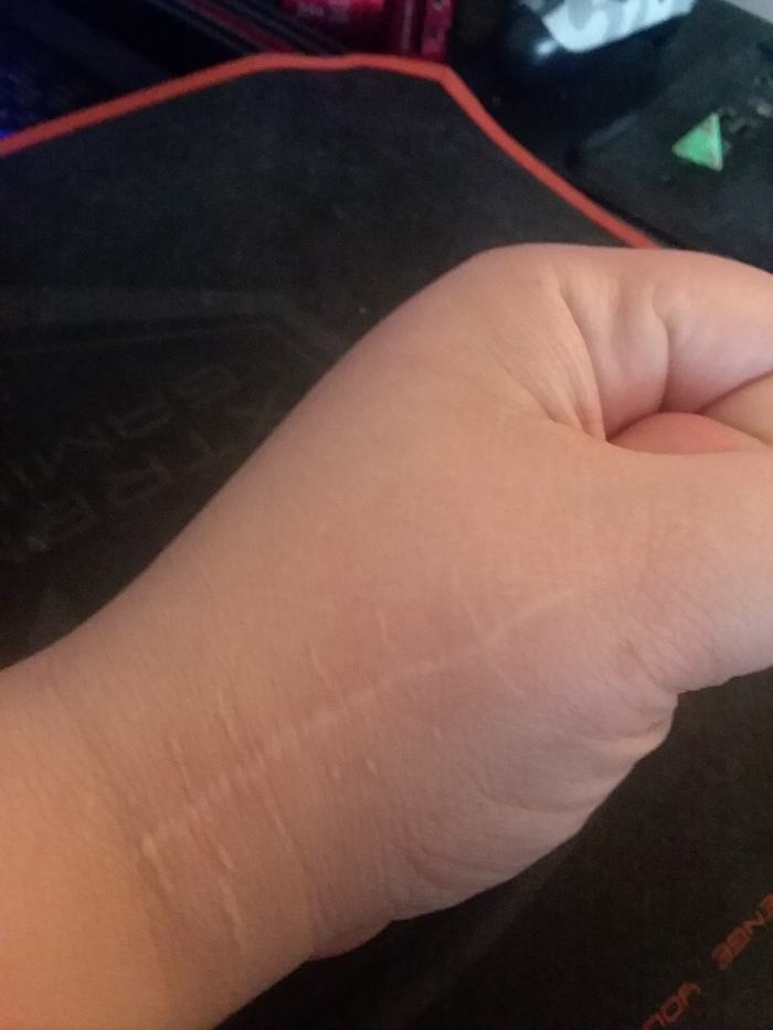 Two years later, the scar from my surgery remains. It looks real good for what happened. I can feel the tiny plate and pins holding my thumb in place. They give me a 'weather-sense' of sort.