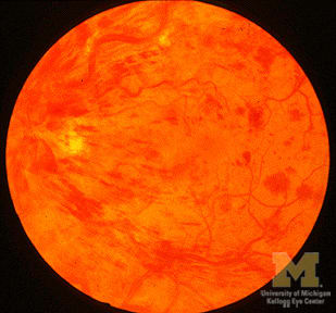 This is a photograpgh of a retina following a retinal vein occlusion. The occlusion, caused by a blood clot, effectively stops blood leaving the retina. This kills the light sensitive cells, reducing vision rapidly, causing Blindness