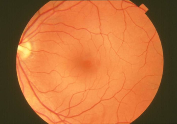This is a photograph of a Normal healthy Retina, note the defined blood vessels as compared to the Retina below