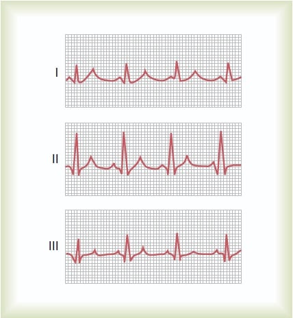 How to read a normal ECG(Electrocardiogram)? - HubPages