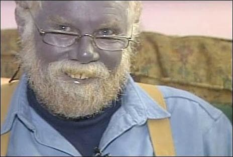Paul Karason developed blue skin after using colloidal silver. Ironically, he was trying to treat a skin condition.