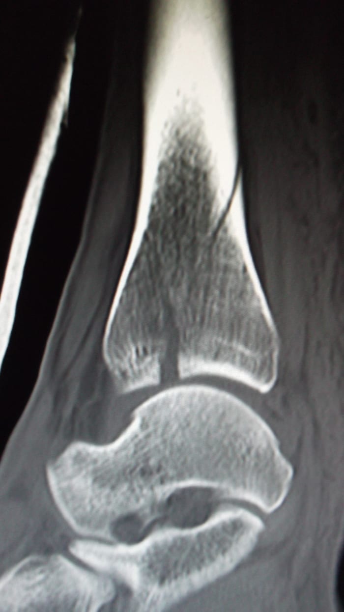 Every broken ankle x-ray showed damage. A different angle, a different broken bone.