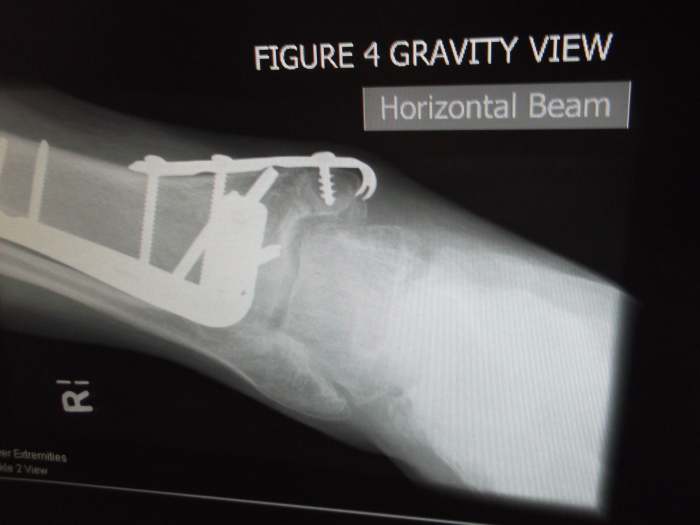 This is one of the later x-rays taken of my husband's ankle after surgery. It is a 'gravity view', clearly marked on the x-ray..