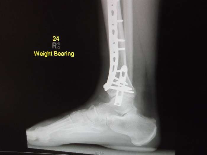 One of the 'weight bearing' xrays taken of his broken ankle. This is one of the side views. It is interesting to see the exact positioning of the plates and screws.