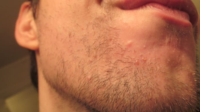 This is 8 days into using tea tree oil, and my acne was way worse! Hence, I had to take the close-up!