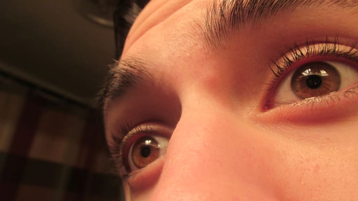 Another cystic acne mark on the inside edge of the bridge of my nose, due to my use of 100% undiluted tea tree oil.