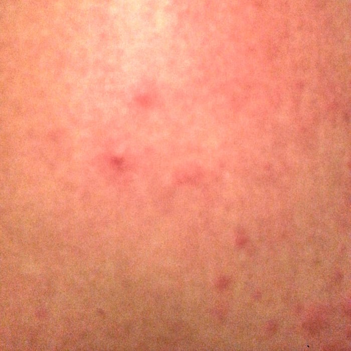 A picture of the back of my leg during one of my more severe breakouts. The red inflamed dots appear for about an hour, get increasingly swollen and irritating, then go away.