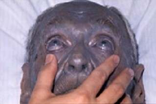 A case of argyria. Argyria has no known effect on health.