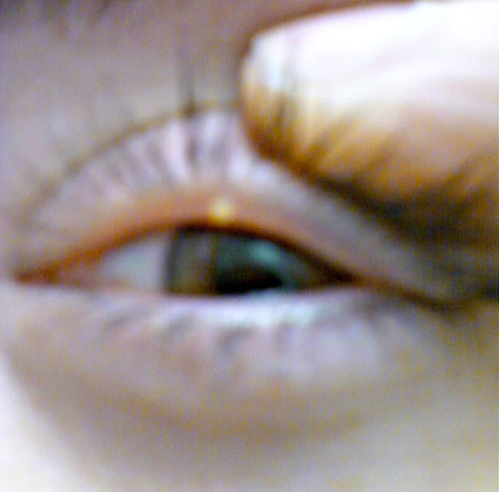 Stye under eyelid