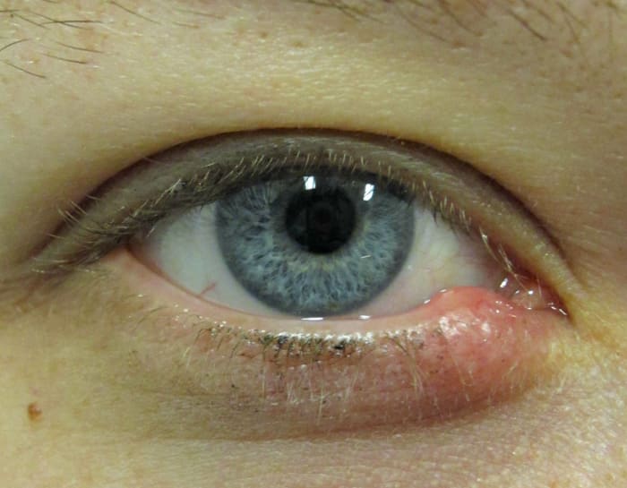 Stye lower lid